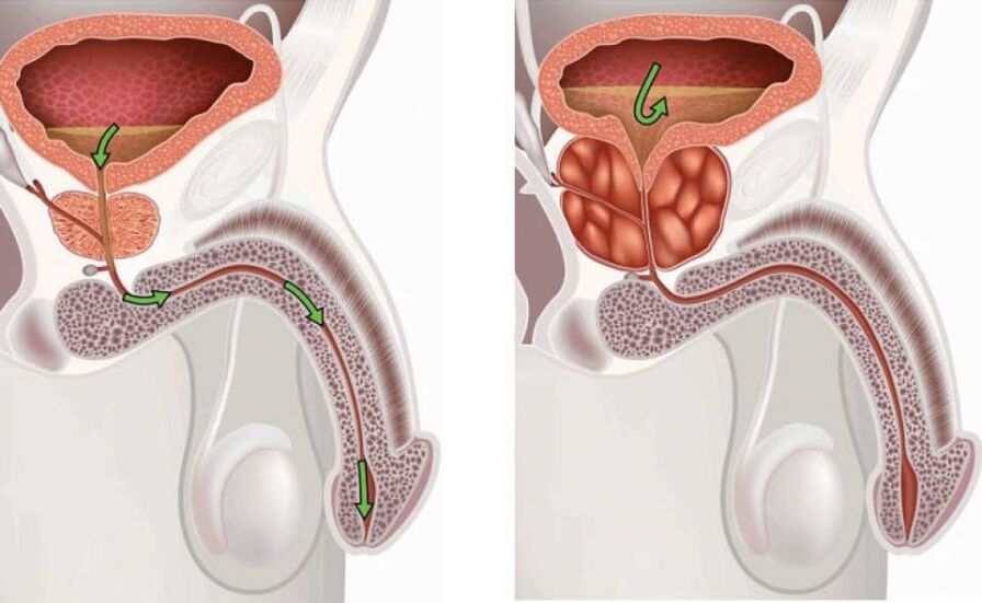 Informations sur la maladie de la prostatite