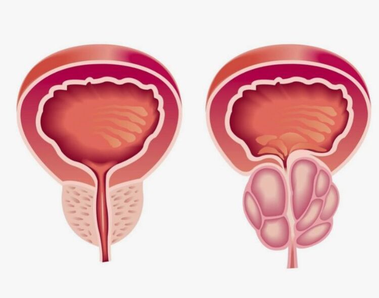 prostate saine et malade